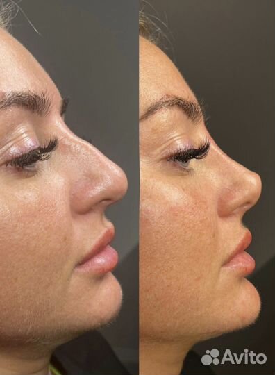 Уменьшение носика навсегда