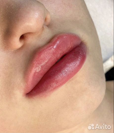 Биоревитализация