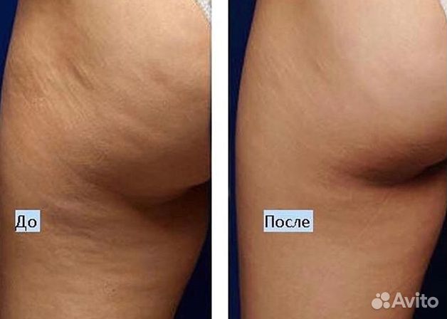 РФ лифтинг тела и лица (велашейп Anchorfree V8c2)