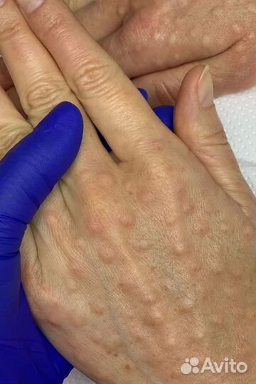 Коктейль монако мезотерапия биоревит липолитики