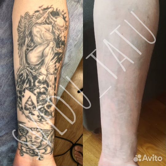 Лазерное удаление татуировок и татуажа Пирсинг