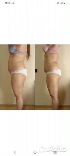 Антицеллюлитный массаж аппаратный