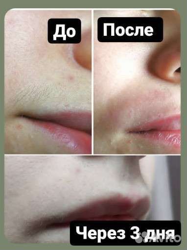 Электроэпиляция. Депиляция. ваксинг/шугаринг