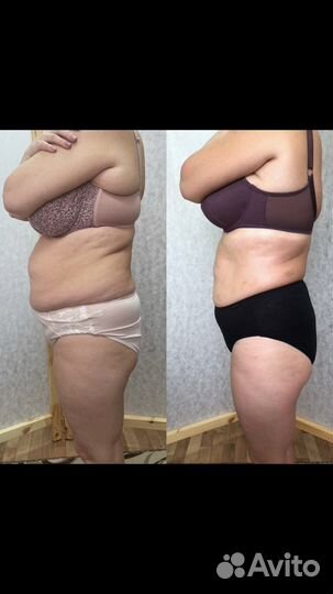 Антицеллюлитный массаж