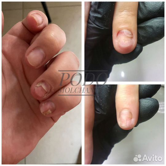 Подолог. Работа с проблемами стопы. Вросший ноготь