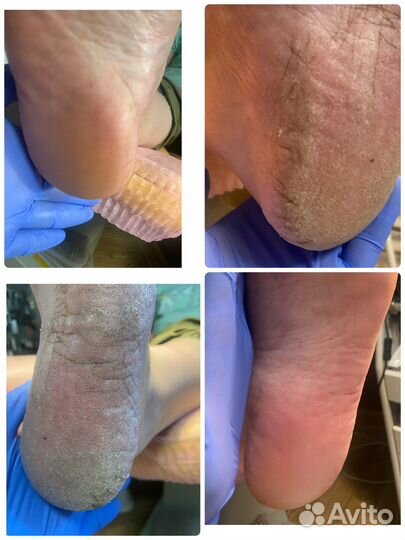 Титановые нити педикюр