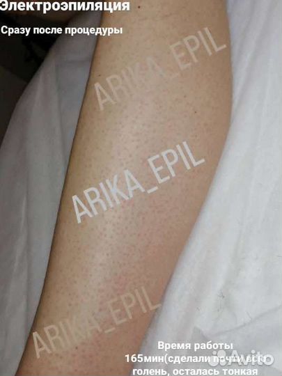 Электроэпиляция. Депиляция. ваксинг/шугаринг
