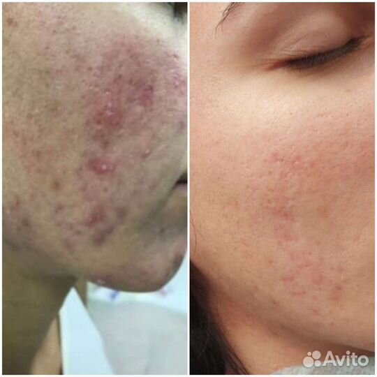 Косметолог, массаж, пилинг, чистка, аппарат массаж