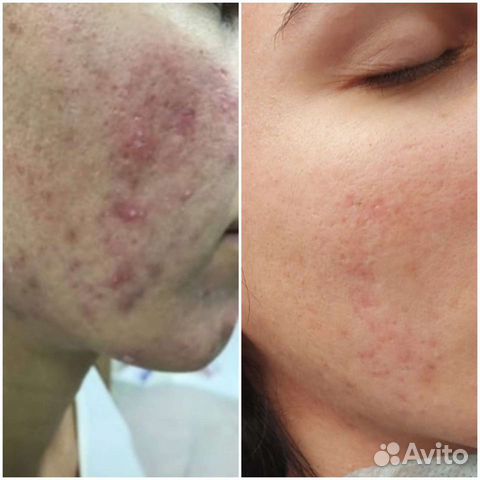 Косметолог, массаж, пилинг, чистка, аппарат массаж