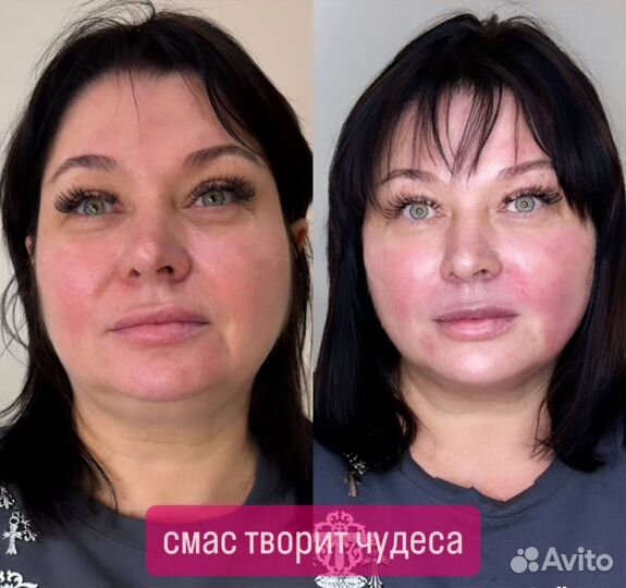 Модель на СМАС лифтинг бесплатно