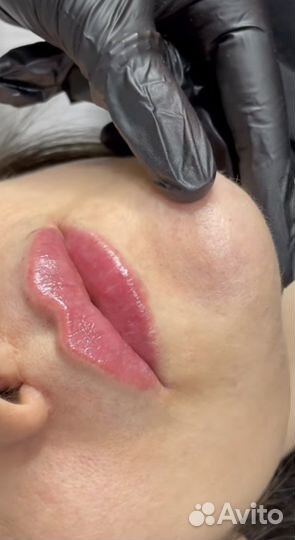 Увеличение губ