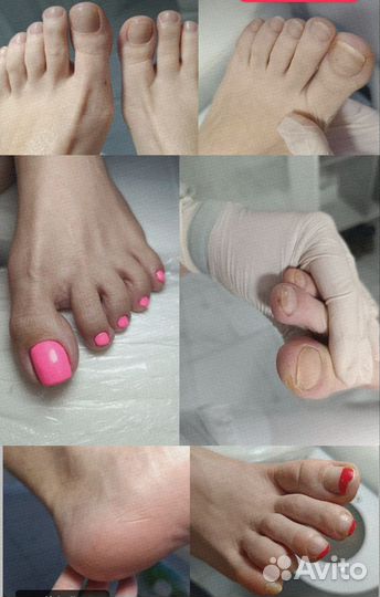 Медицинский педикюр, подолог Адлер