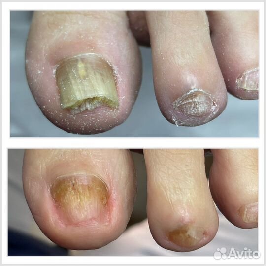 Подологический педикюр