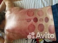 Массаж баночный