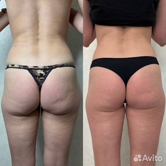 Подтяжка лица Сахарный Лифтинг Шугаринг