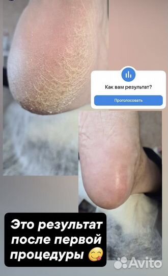 Педикюр на дому