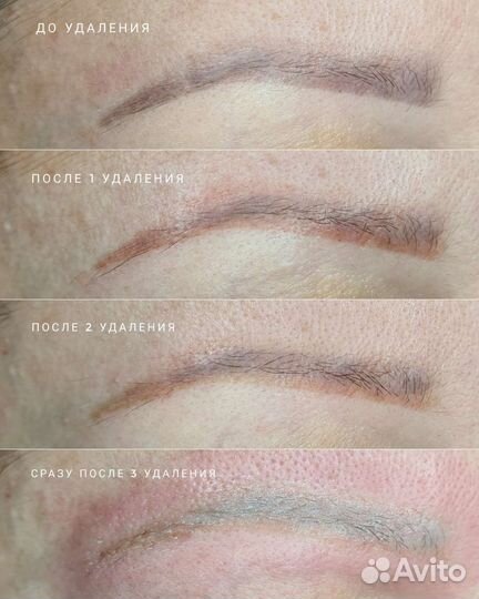 Удаление татуажа лазером