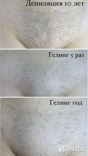 Гелинг депиляция