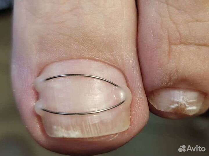 Подолог, Педикюр гель лак,Вросший ногть,грибок