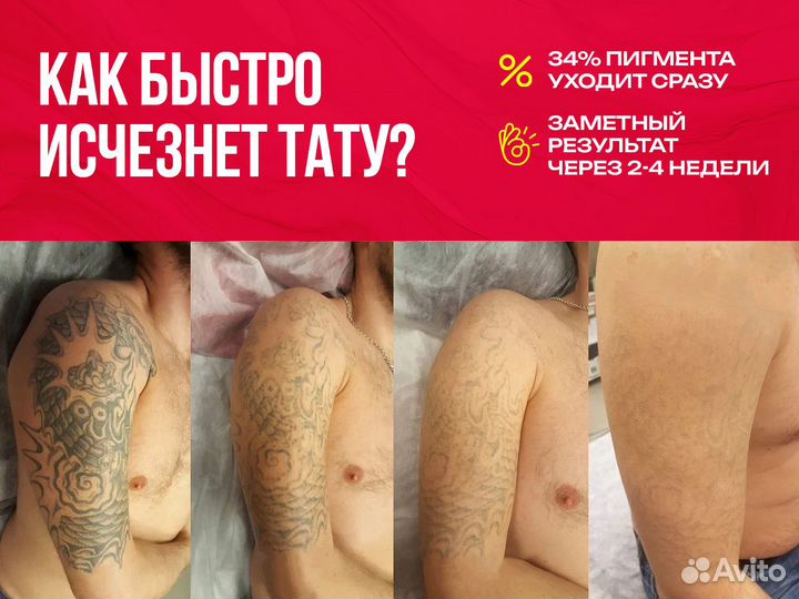 Лазерное удаление тату, татуировки, татуаж