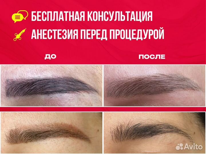 Лазерное удаление тату, татуировки, татуаж