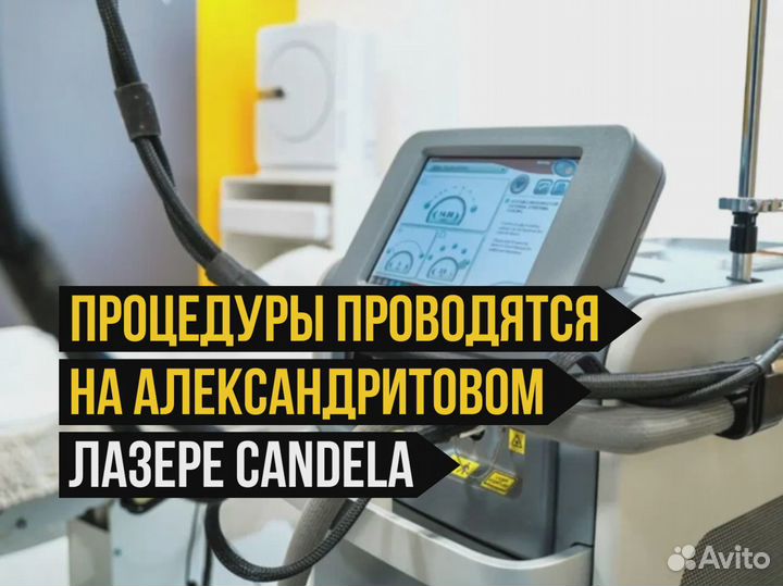 Лазерная эпиляция