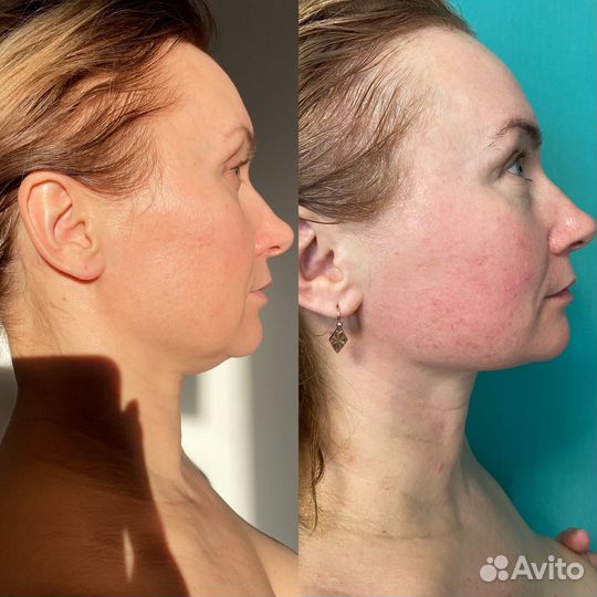 LPG массаж тела и лица. Ручной массаж. Медовый