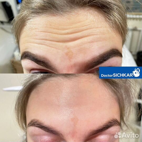 Ботокс для лица / Ботулинотерапия / Диспорт