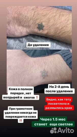 Лазерное удаление татуажа, татуировок