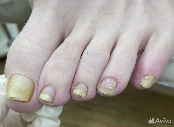 Лечебный педикюр подолог