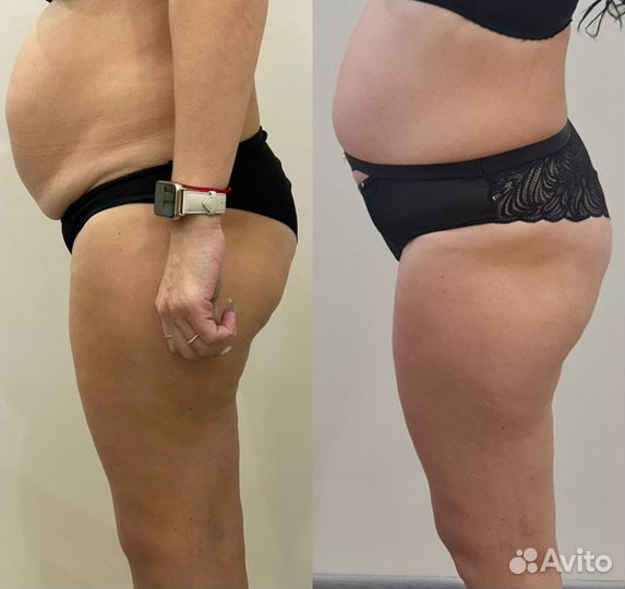 Аппаратный LPG массаж