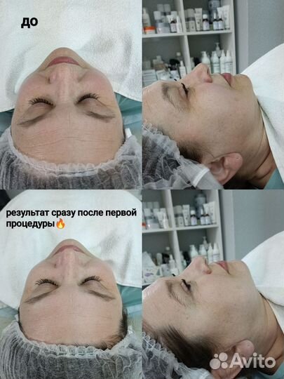 УЗ чистка лица (9 этапов )