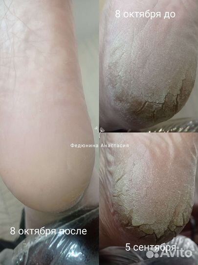 Подолог, Педикюр, SMART, Медицинский педикюр