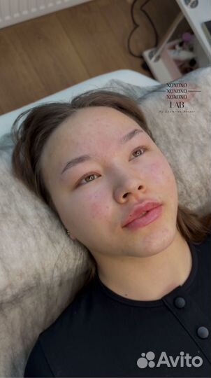 Увеличение губ,биоревитализация,мезотерапия