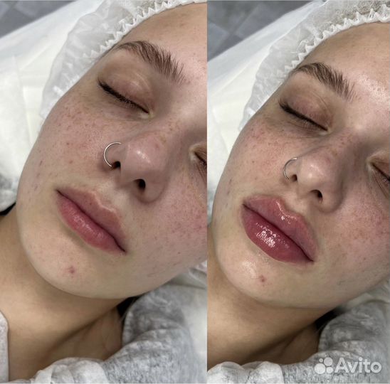 Косметолог, увеличение губ, мезо, чистка лица