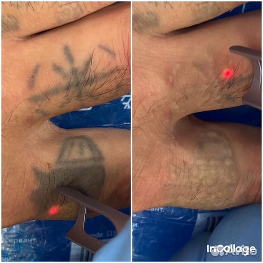 Удаление татуажа/тату