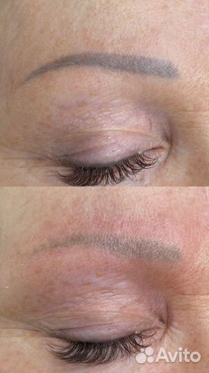 Лазерное удаления тату/татуажа/ /обучение/ модели