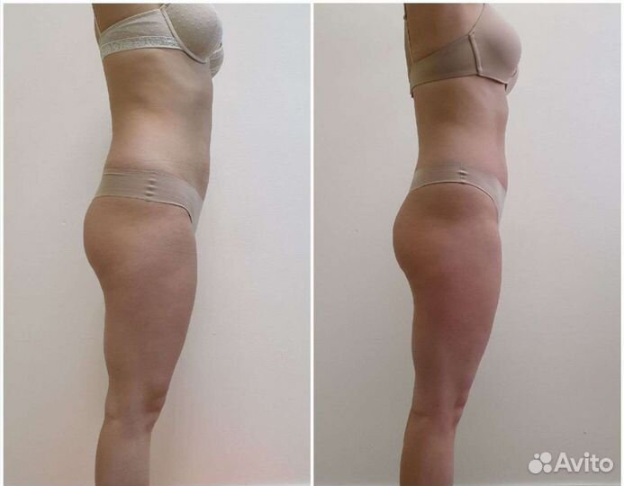 LPG массаж на самом мощном аппарате