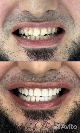 Изготовление композитных винир