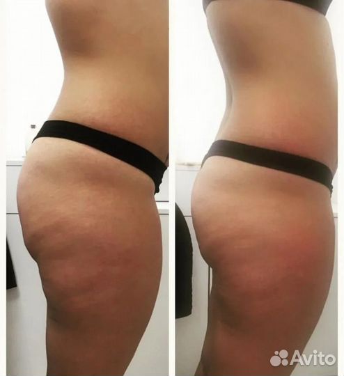 Вакуумный массаж, модели, коррекция фигуры