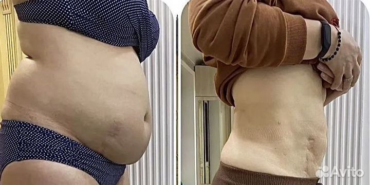 Криолиполиз