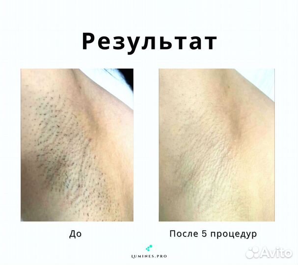 Аппарат для эпиляции Lumines Max’One 1200