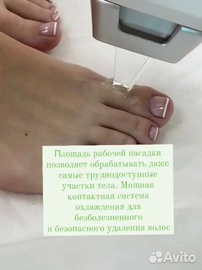 Лазерная эпиляция