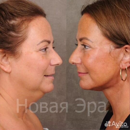 Ультра омоложение /подтяжка лица/ Минус 15 лет за