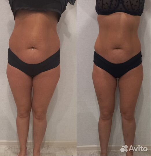 Антицеллюлитный массаж,коррекция фигуры,кавитация