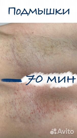 Электроэпиляция: бёдра