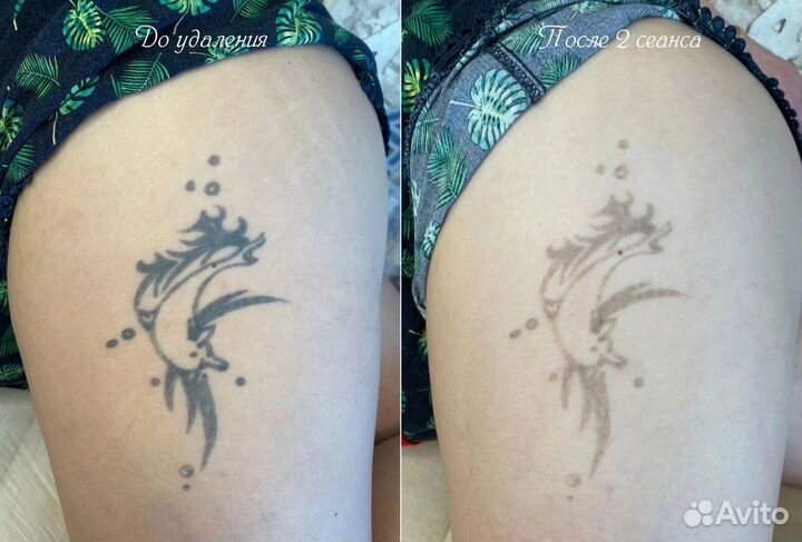 Удаление Татуажа и Тату без Шрамов и Ожогов