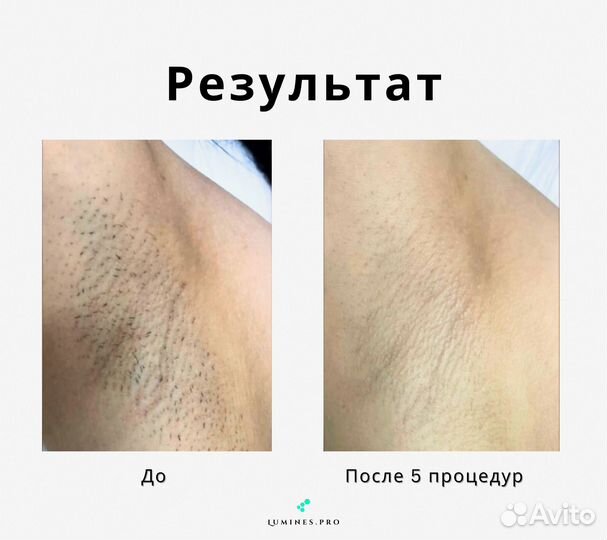 Диодный лазер Lumines максван 1200