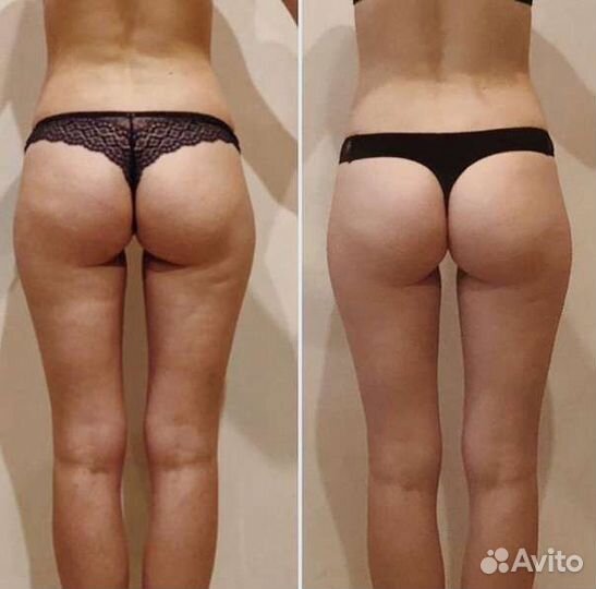 Аппаратный массаж тела