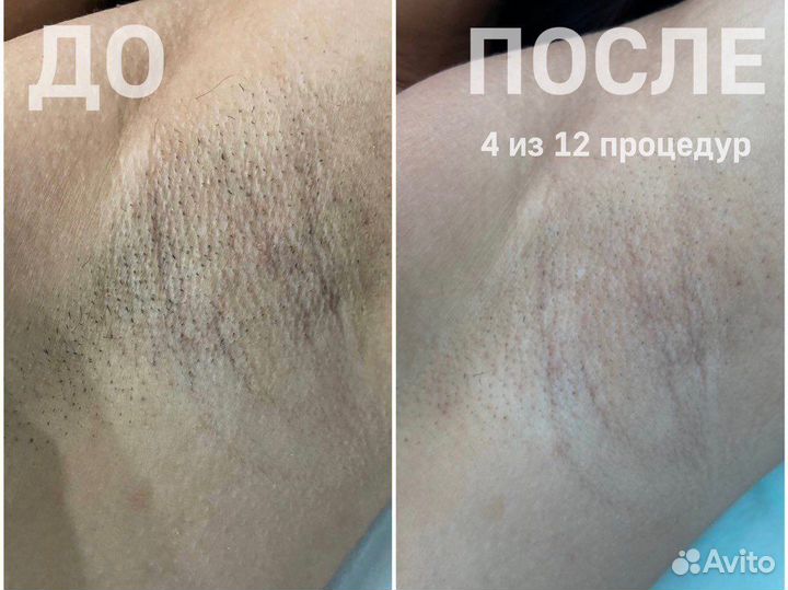 Лазерная эпиляция